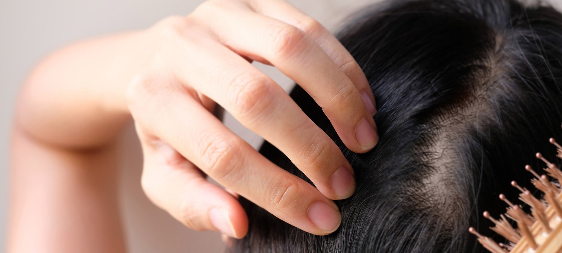 Hair Loss Signs Of Alopecia