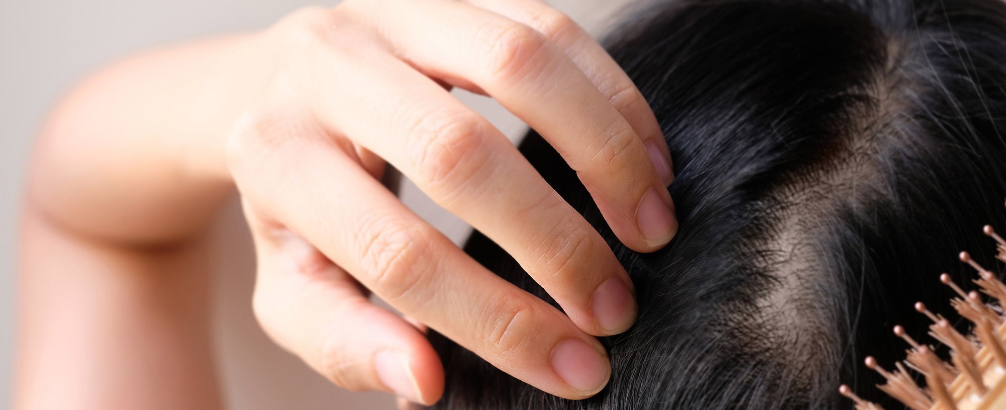 Hair Loss Signs Of Alopecia