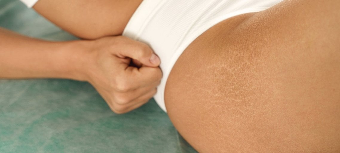 HOW TO COVER STRETCH MARKS ON ARMS WITH MAKEUP