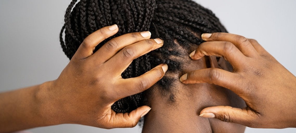 Scalp psoriasis Symptoms causes and treatment