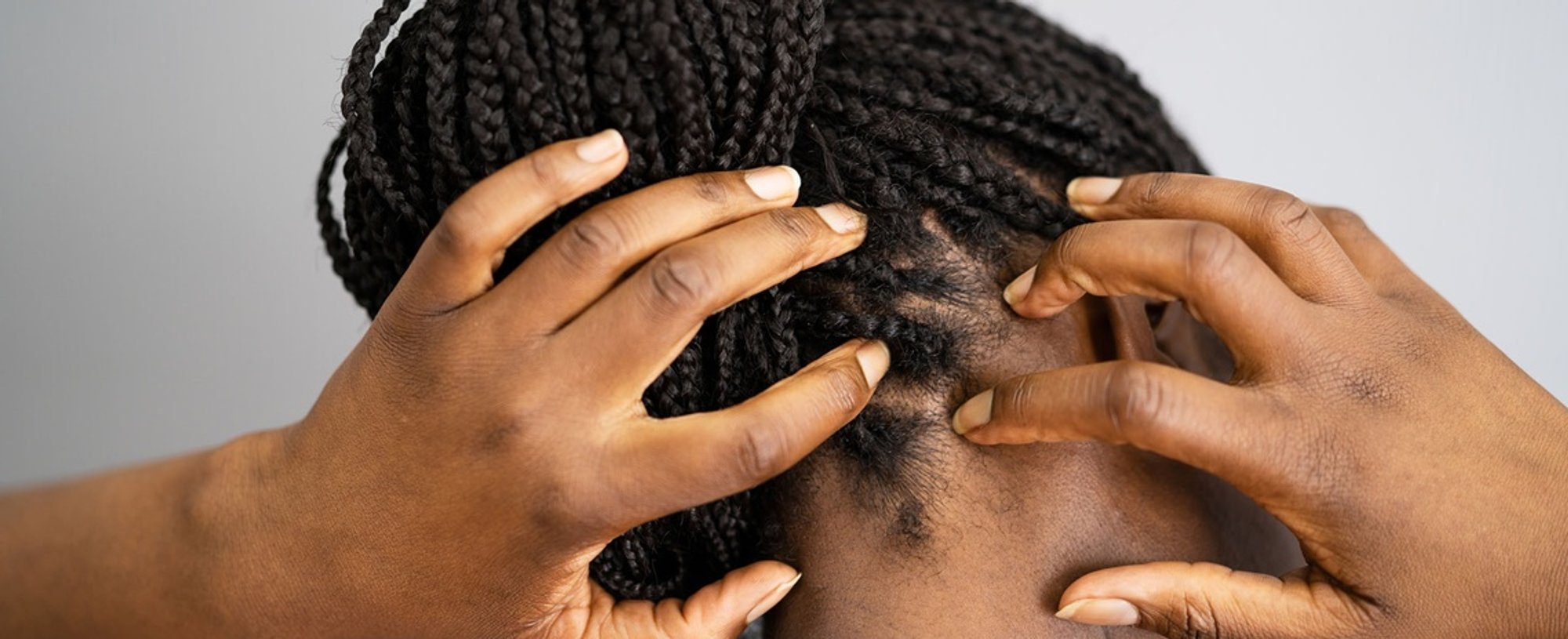 What Is Scalp Psoriasis