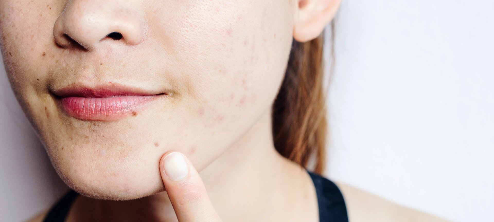 Clogged Pores What Causes Them And How