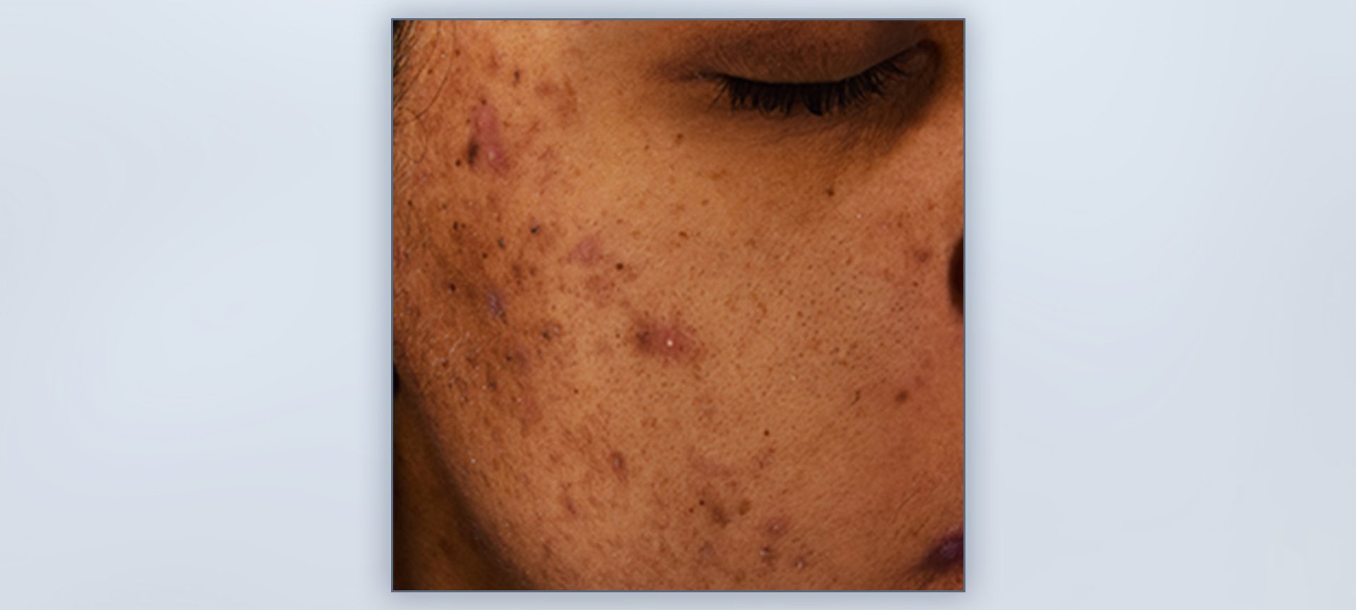 Blemishes face best sale