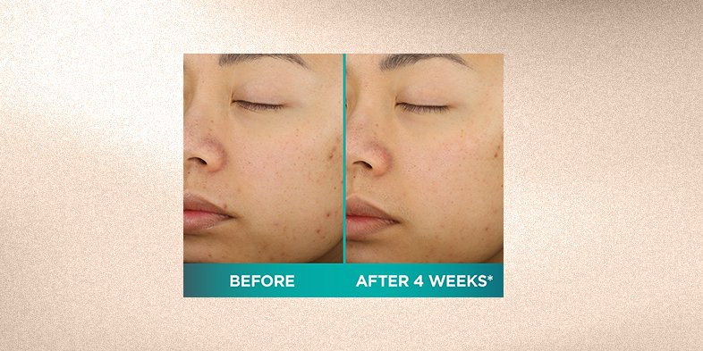 What Are Alpha Hydroxy Acids? AHAs How To | L’Oréal Paris