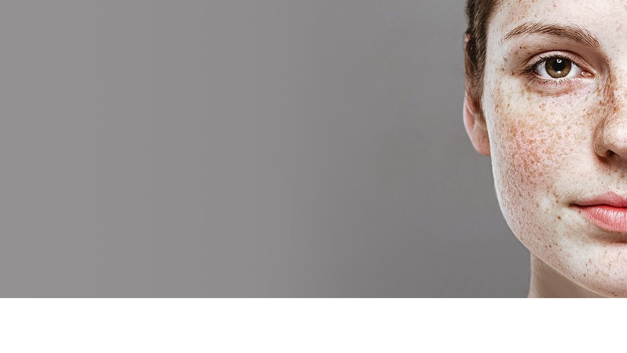 Can You Get Rid Of Freckles? - L'oréal Paris