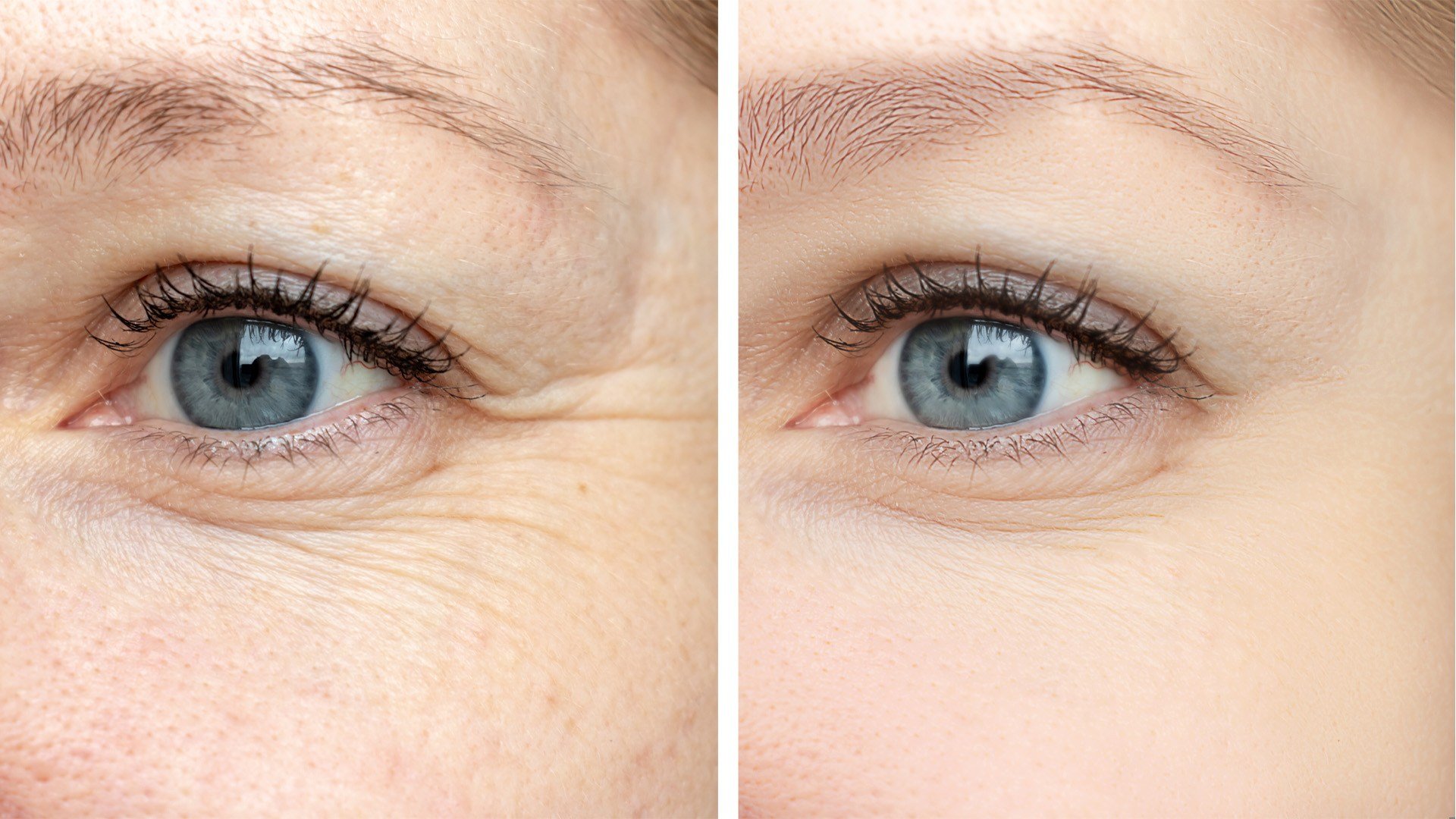 Loreal Paris Article How To Manage Under Eye Wrinkles And Lines D