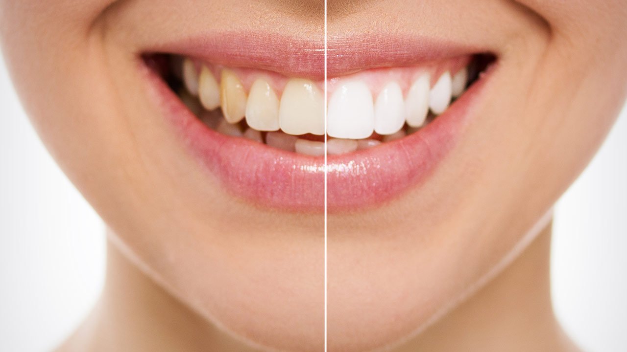 Loreal Paris BMAG Article teeth whitening your guide on how to get white teeth D