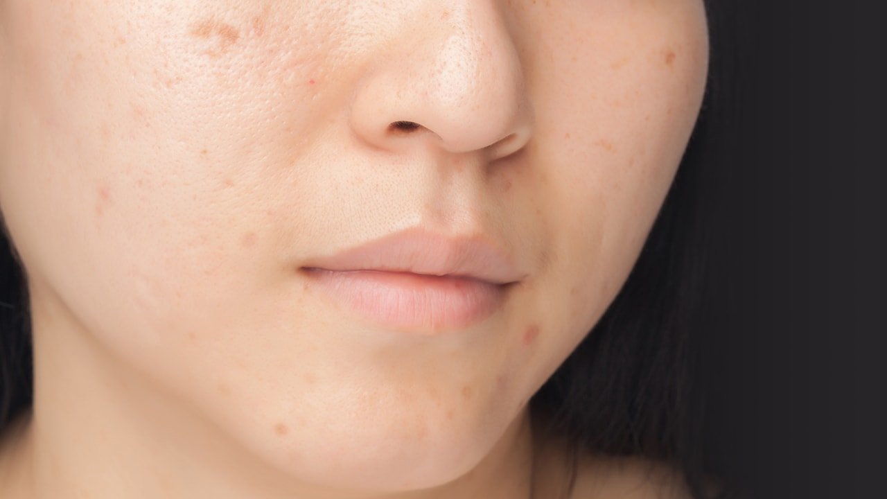 L'Oreal Paris Skin Care Concerns: Getting Rid Of Dark Spots