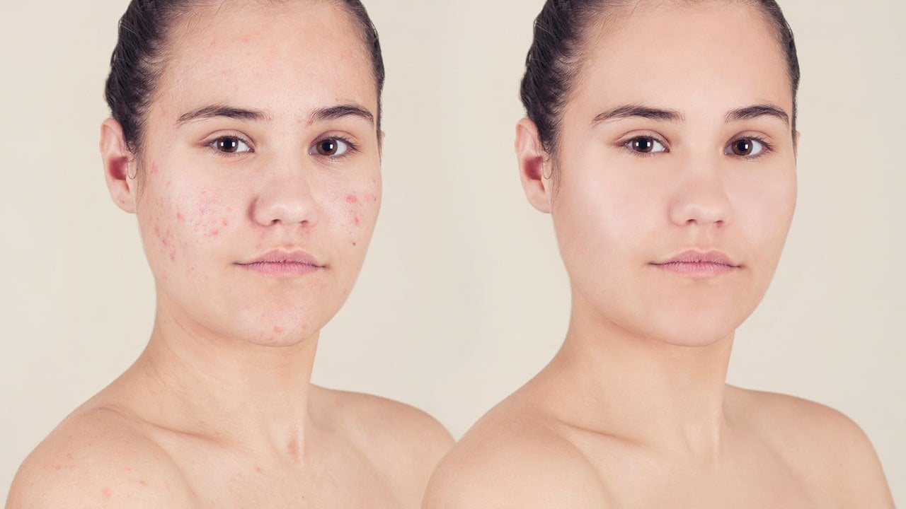 Træts webspindel forbruge omgivet How to Cover Up Acne with Makeup - L'Oréal Paris