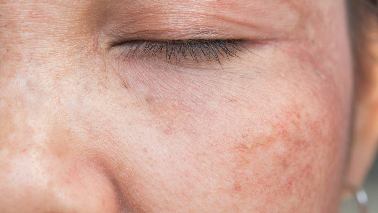 Sun Spots on Skin How to Protect Your Complexion L’Oréal Paris Sun Spots on Skin How to Protect Your Complexion L’Oréal Paris