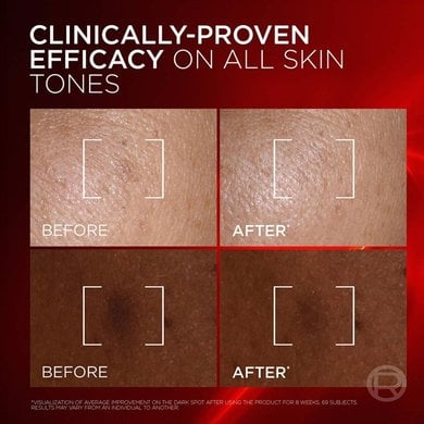 09042026 Oap Revitalift Laser Melasyl Creamy Serum Before After Dmi Website